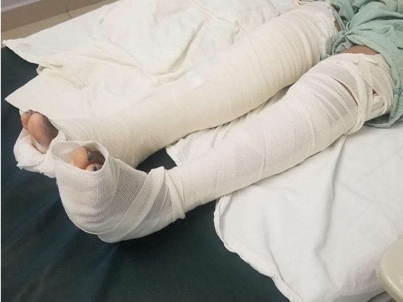 Piden apoyo para guatemalteco que requiere operaci&oacute;n tras ser atropellado en Piedras Negras