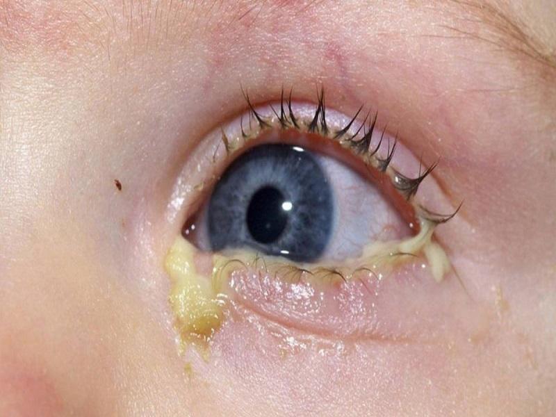 Picazón y secreción ocular son síntomas de conjuntivitis