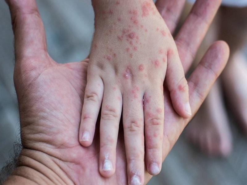 Detectan caso de sarampión en niña de 8 años en la CDMX