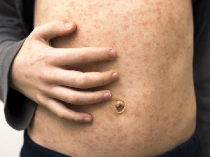 Van 81 casos de sarampi&oacute;n en M&eacute;xico; la mayor&iacute;a sin antecedentes de vacuna