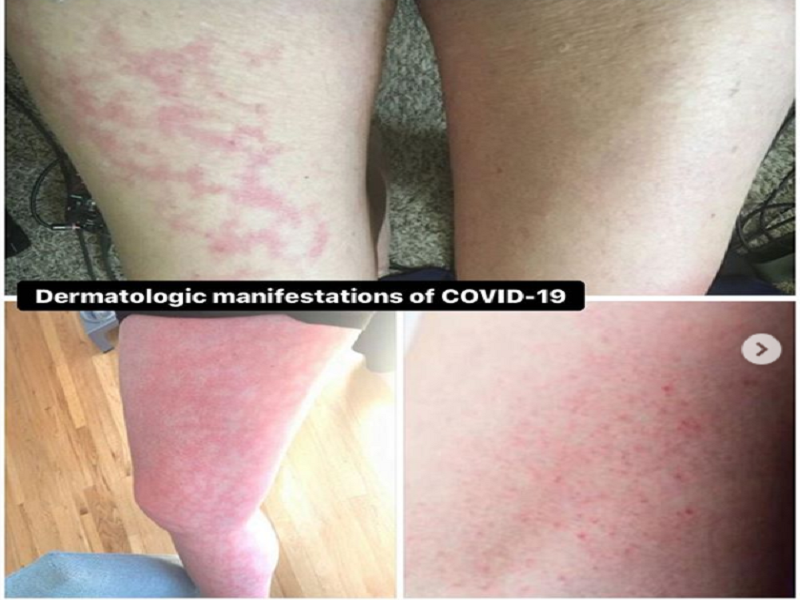 Erupciones e infecciones en la piel, otro raro s&iacute;ntoma del coronavirus en j&oacute;venes 