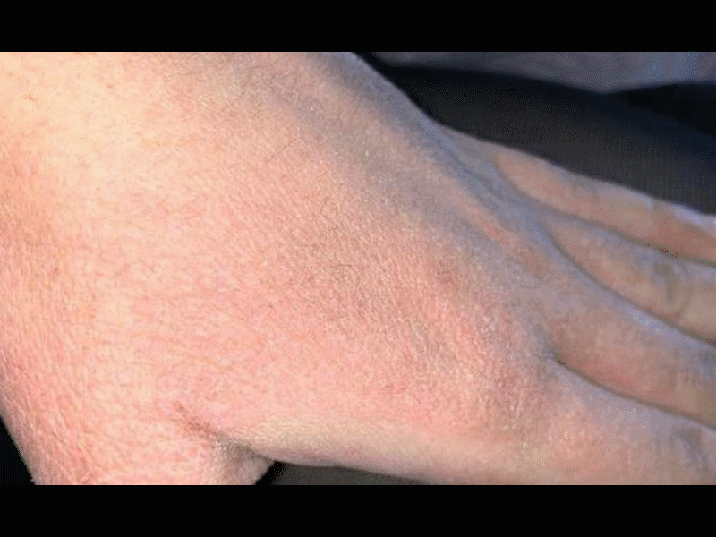 Uso excesivo de gel antibacterial y sanitizantes pueden causar reacciones al&eacute;rgicas