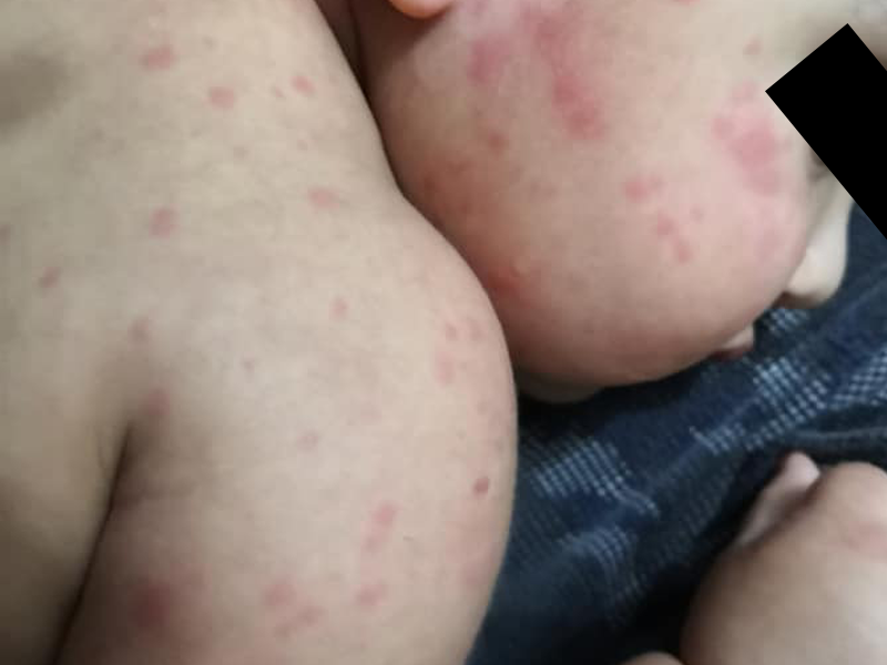 Aumentan casos de salpullido en menores de Acuña, es uno de los síntomas más raros del COVID-19