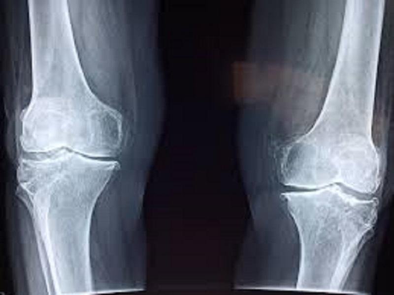 Alimentaci&oacute;n adecuada y actividad f&iacute;sica ayudan a tener huesos sanos