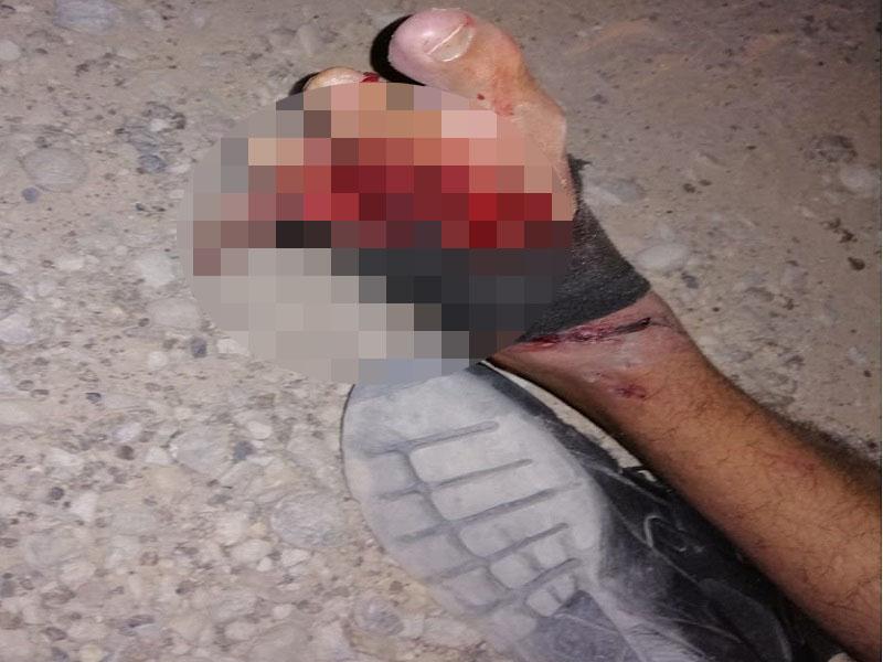 Le amputan varios dedos del pie izquierdo a motociclista responsable de provocar un accidente