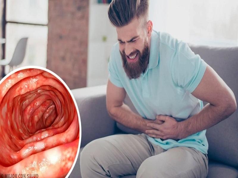 Se deben modificar h&aacute;bitos alimenticios para prevenir la colitis, tiene que ver con el estr&eacute;s