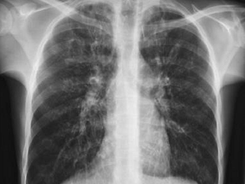 Piden a pacientes que terminaron aislamiento y quedaron con limitaci&oacute;n pulmonar que se atiendan 