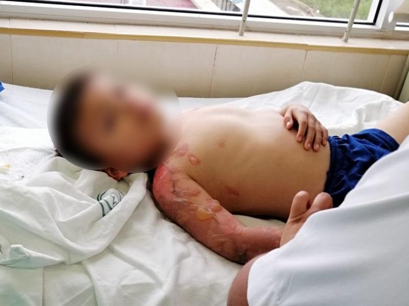 Menor de 4 a&ntilde;os result&oacute; con quemaduras de segundo grado tras caerle agua hirviendo encima