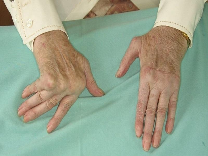 Detección oportuna y apego al tratamiento evitan deformaciones por artritis
