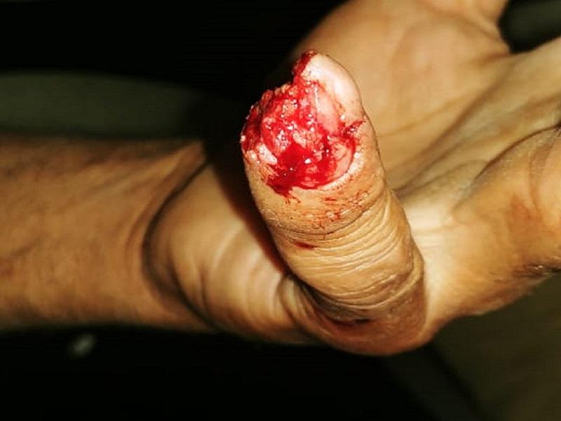 Sujeto le arranca un pedazo de un dedo de la mano a su pap&aacute; 