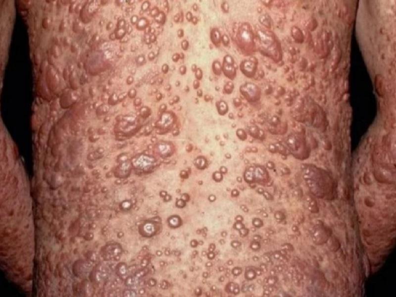 Confirman al menos 89 casos de lepra en M&eacute;xico este 2020