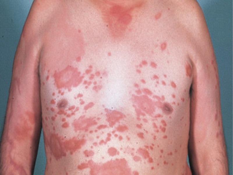 Este domingo es el D&iacute;a Mundial de la Lepra, no hay casos en Piedras Negras (video)