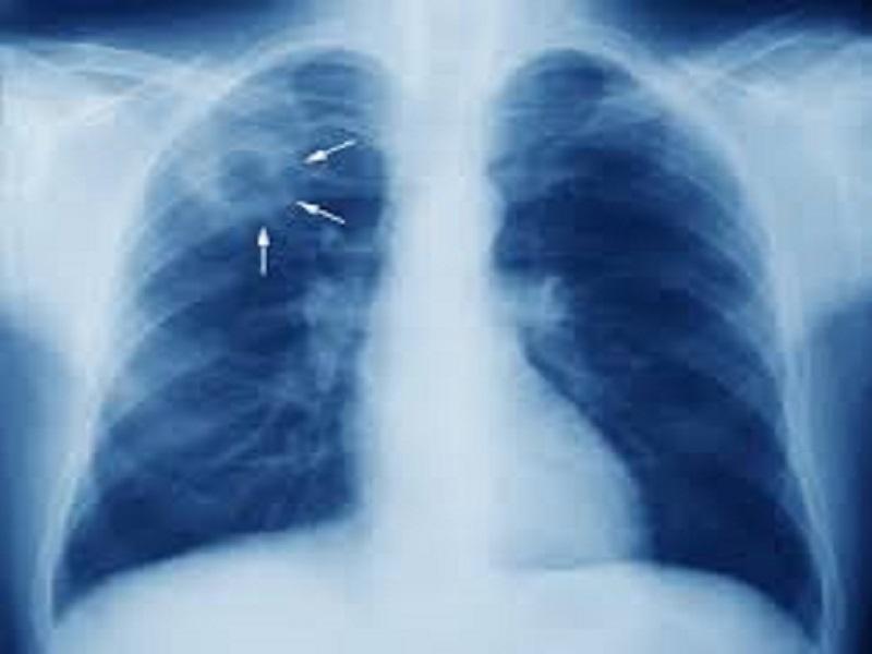 Tos de 15 días o más podría ser síntoma de tuberculosis (video)