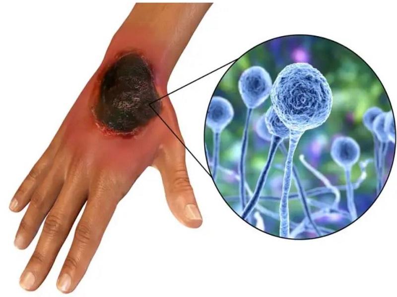 El hongo negro no es exclusivo de pacientes COVID (video)