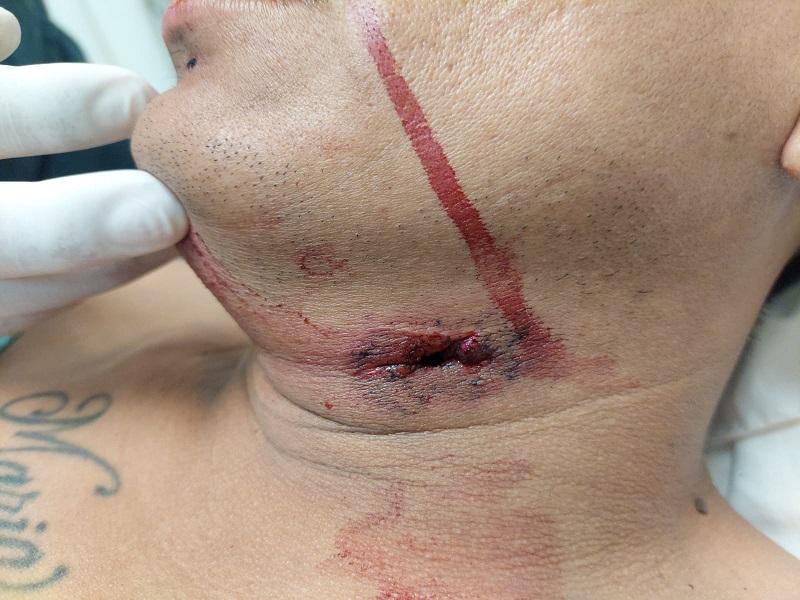 Hospitalizan a hombre lesionado en el cuello, lo reportan grave