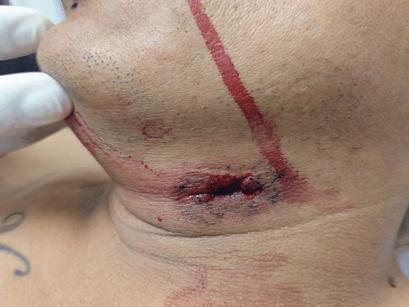 Reportan estable a hombre lesionado en el cuello con arma blanca en Piedras Negras