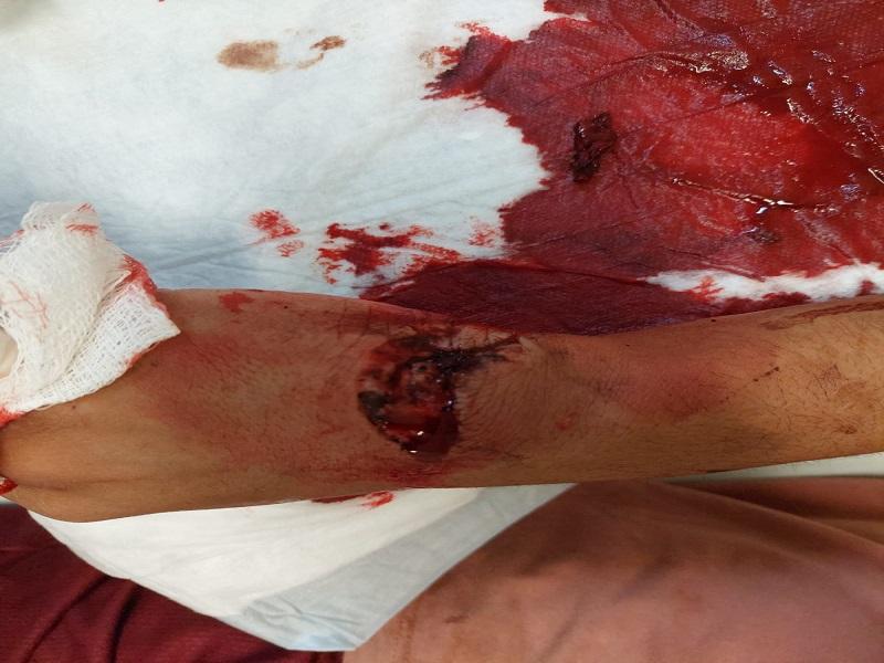 Lesionan a machetazos a un joven durante una riña en Piedras Negras (video)