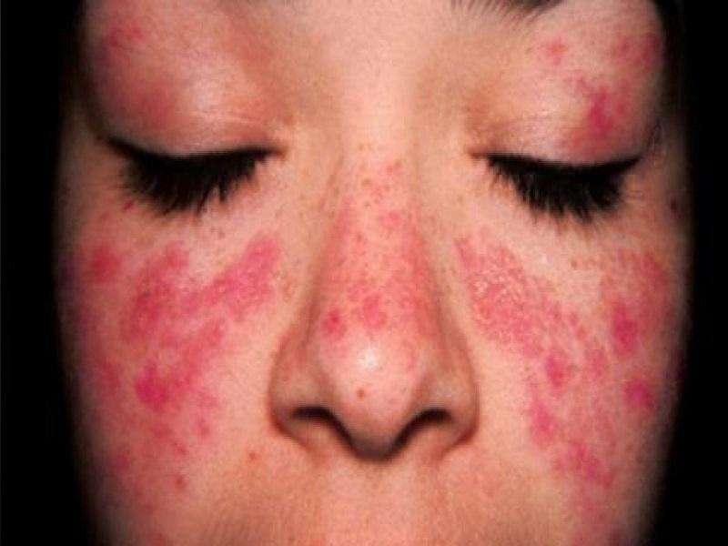 Informa IMSS Coahuila sobre oportunidad en el tratamiento del lupus para mejor calidad de vida