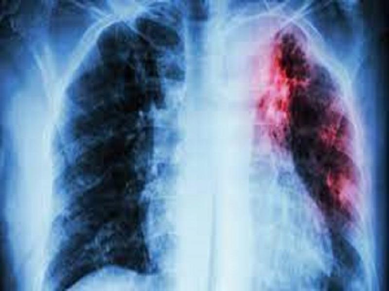 En temporada invernal personas con enfermedades respiratorias deben acudir a revisión médica